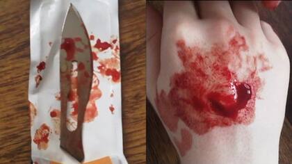 La incisión que le hizo su amiga se veía alarmante, pero para Lepht, el dolor es secundario.