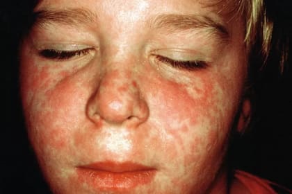 La infección de sarampión genera inmunidad de por vida contra ese virus