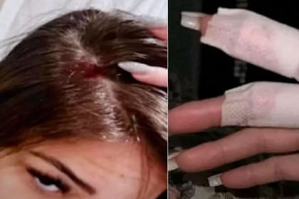 La influencer Gabriela Cavallin exhibió heridas en su cuero cabelludo, supuestamente provocadas por Antony