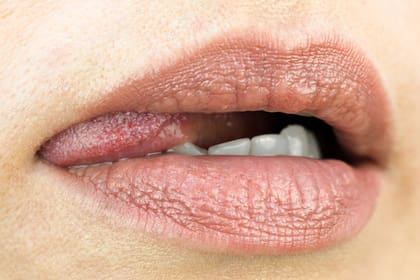 “La lengua es un órgano que hay que examinar, siempre que presente alguna patología lingual u oral", afirman expertos