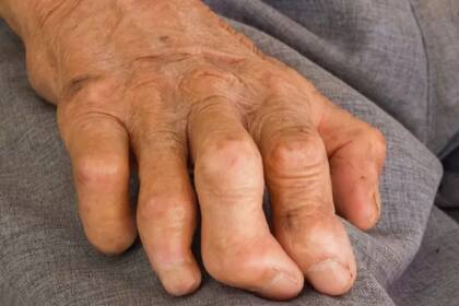 La lepra puede dañar los nervios y provocar discapacidad