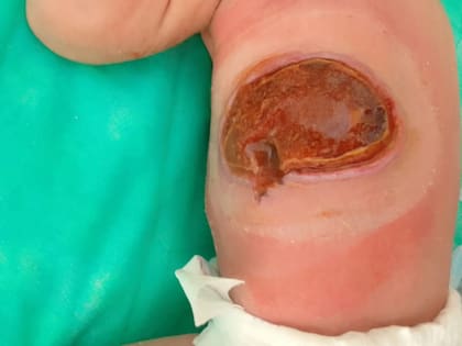 La lesión que la inyección deliberada de potasio provocó a Pilar Martín, poco después de su nacimiento