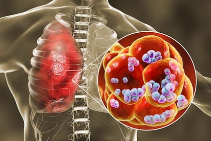 La mala higiene oral pueda provocar que las bacterias sean inhaladas hacia los pulmones y causar infecciones como la neumonía