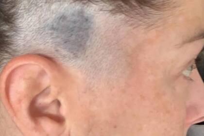 La mancha color azul grisáceo que apareció en el cuero cabelludo de Lee King era una afección llamada nevus azul, que en general no es maligno, pero cuya evolución es necesario seguir de cerca