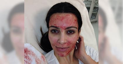 La modelo Kim Kardashian ayudó a popularizar este tratamiento