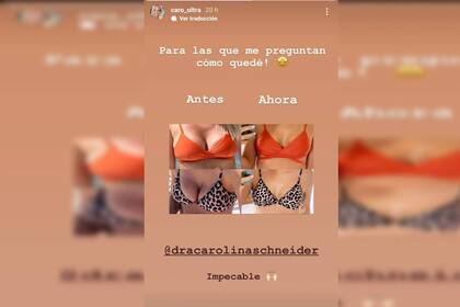 La modelo mostró los resultados físicos al quitarse los implantes mamarios (Foto Instagram @caro_oltra)