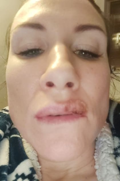 La mujer dice que las complicaciones en su labio le trajeron un sufrimiento físico y también mental y que se sentía avergonzada por lo que le pasaba