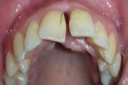 La mujer presenta uno de los pocos casos en el mundo de hirsutismo gingival