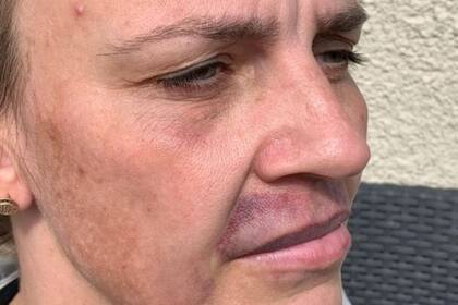 La mujer ya se había realizado unos cinco tratamiento similares años atrás