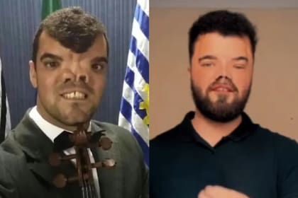 La nariz bífida le provocó ser objeto de burlas hasta que pudo operarse