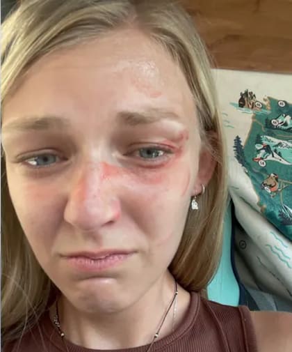 La nueva imagen que muestra las lesiones de la influencer Gabby Petito