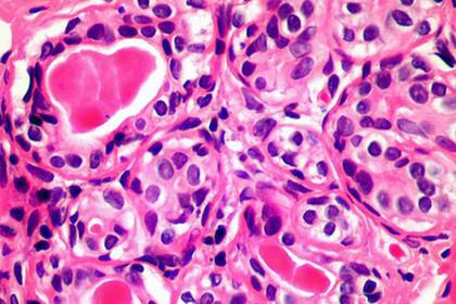 El primer control debe realizarse a los 50 años pero esto es así necesariamente si la persona no registra antecedentes de ningún tipo de cáncer en la familia