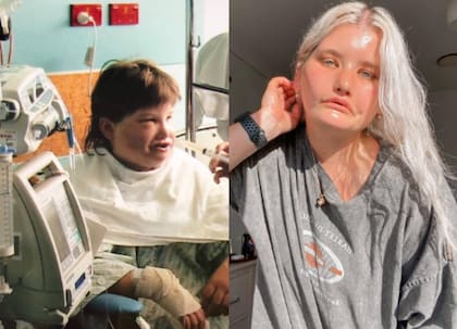 La operación de ocho horas y de meses de recuperación no tuvo éxito