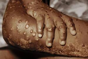 La Organización Mundial de la Salud (OMS) no está lejos de declarar la pandemia de viruela de mono a nivel global