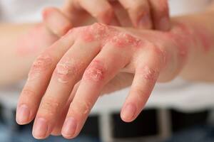 La región, en vilo por el regreso de una enfermedad viral altamente contagiosa