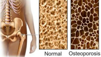 La osteosporosis es una enfermedad progresiva que avanza producto del deterioro de los huesos