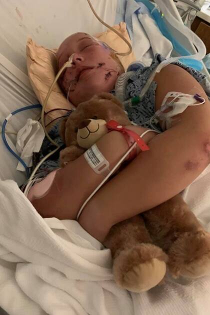 La pequeña lucha por su vida tras el brutal ataque de los perros, que le sacaron gran parte de su cuero cabelludo, le arrancaron una oreja y le aplastaron la traquea