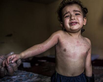 La pequeña Shahad, de tres años, con el cuerpo ampollado por el armamento de Estado Islámico