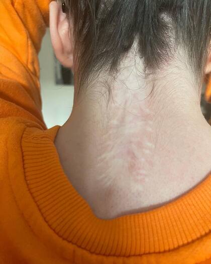 La pequeña tuvo que someterse a dos cirugías de columna.