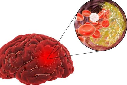 La pérdida del glicocálix también se ha relacionado con los ictus cerebrales.