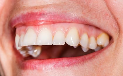 La periodontitis o enfermedad de las encías, es la segunda enfermedad oral más extendida después de las caries