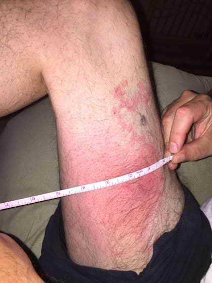 La picadura le provocó una roncha de 20 por 10 centímetros