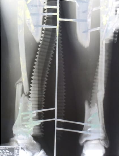 La placa de la operación que pudieron hacerle a Sergio en San Francisco para recuperar la pierna izquierda