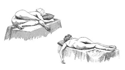 La posición Sims, ilustrada en The American Illustrated Medical Dictionary, de W. A. Newman Dorland, A.M., M.D. (1901)