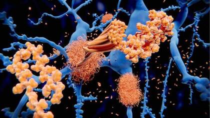 La proteína amiloide se acumula en el cerebro de las personas con Alzhemier