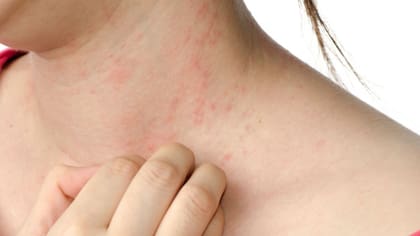 La psoriasis es una enfermedad muy incómoda