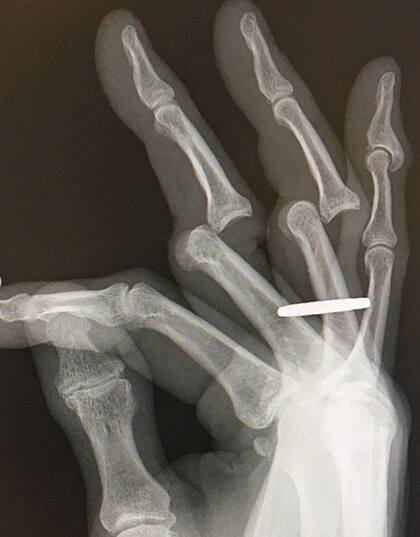 La radiografía de cómo le quedó la mano a Tony Hawk. Fuente: Instagram