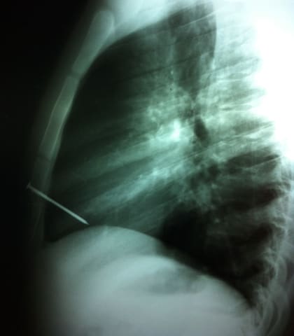 La radiografía muestra el clavo en el tórax
