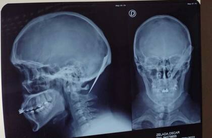 La radiografía que le hicieron a la víctima de 28 años registró cómo quedó el cuchillo en su cabeza