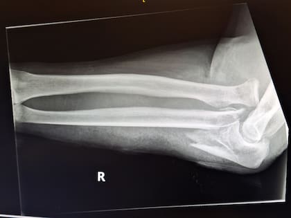 La radiografía que muestra cómo quedó el brazo del buzo