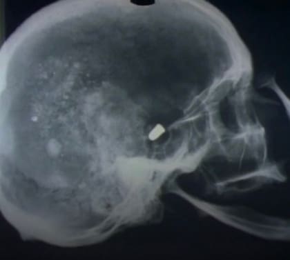 La radiografía que muestra la bala encontrada en el cráneo de la víctima