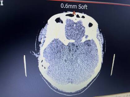 La resonancia magnética encontró un tumor del tamaño de una pelota de tenis