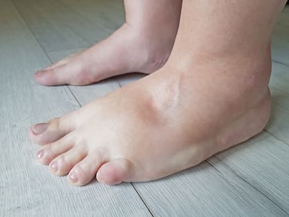 La retención de líquidos puede provocar hinchazón visible en manos pies, tobillos o piernas, entre otros síntomas