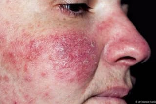 Claves para controlar la rosácea después de los 40