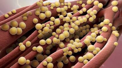 La sepsis o septicemia se produce cuando el sistema inmunológico se sobrecarga y exagera su respuesta ante una infección.