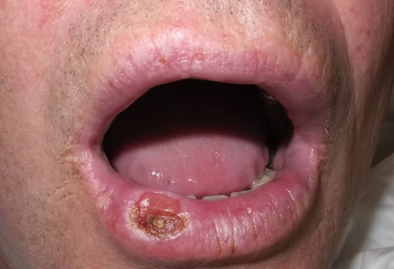 la-sifilis-suele-manifestarse-a-traves-de-KPVF7TY2OJBNNLRNTMT746ELD4