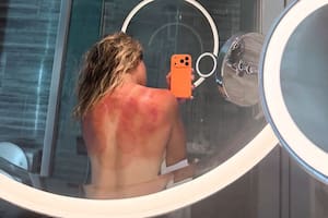 La imagen de la tenista mexicana con la espalda quemada que encendió las alarmas en la previa del Abierto de Australia