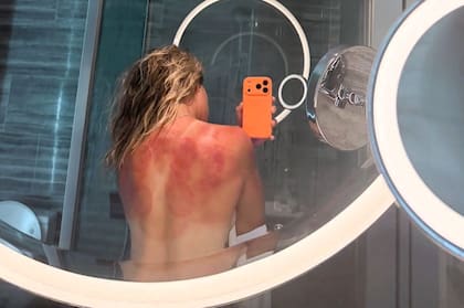 La tenista mexicana Renata Zarazúa exhibió las lesiones cutáneas sufridas tras su partido en Hobart (Instagram @renata_zarazua)