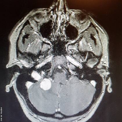 La tomografía, al detectarse el tumor en 2017