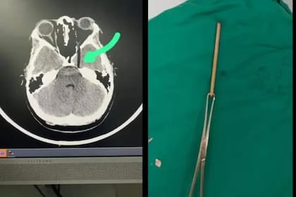 La tomografía y el palo que se había clavado en el ojo de la joven después de la broma con la torta de cumpleaños