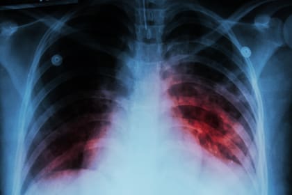 La tuberculosis es una enfermedad infecciosa grave que afecta principalmente a los pulmones y se transmite por el aire