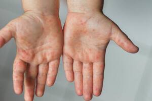 La viruela del mono causa, entre otros síntomas, una erupción cutánea característica