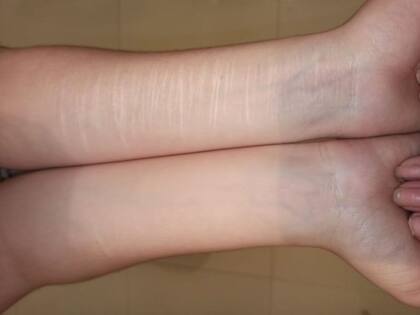 Lara muestra las cicatrices de algunas de las lesiones que se hizo.