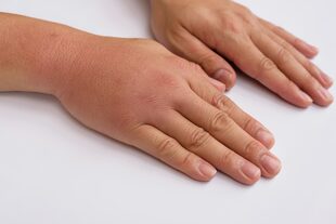qué hinchan las manos y cómo evitarlo - LA