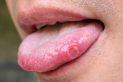 Las ampollas en la lengua pueden ser consecuencia de la sobreingesta de comidas ácidas o picantes, e incluso una respuesta al estrés crónico