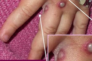 Cuáles son los síntomas de la variante Mpox Clado Ib